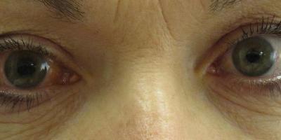 Screening tests help diagnose glaucoma