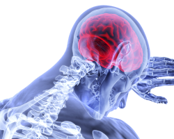 Udar mózgu – jak zapobiegać, jak rozpoznać?