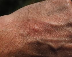 Kurzajki - co to takiego, jak się ich pozbyć 