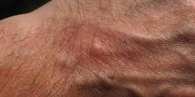 Kurzajki - co to takiego, jak się ich pozbyć 